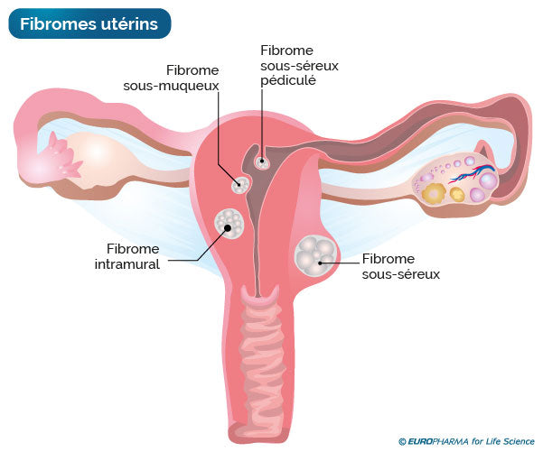 Cure Fibrome Décongestion | Infusion 100% naturelle | 21 jours