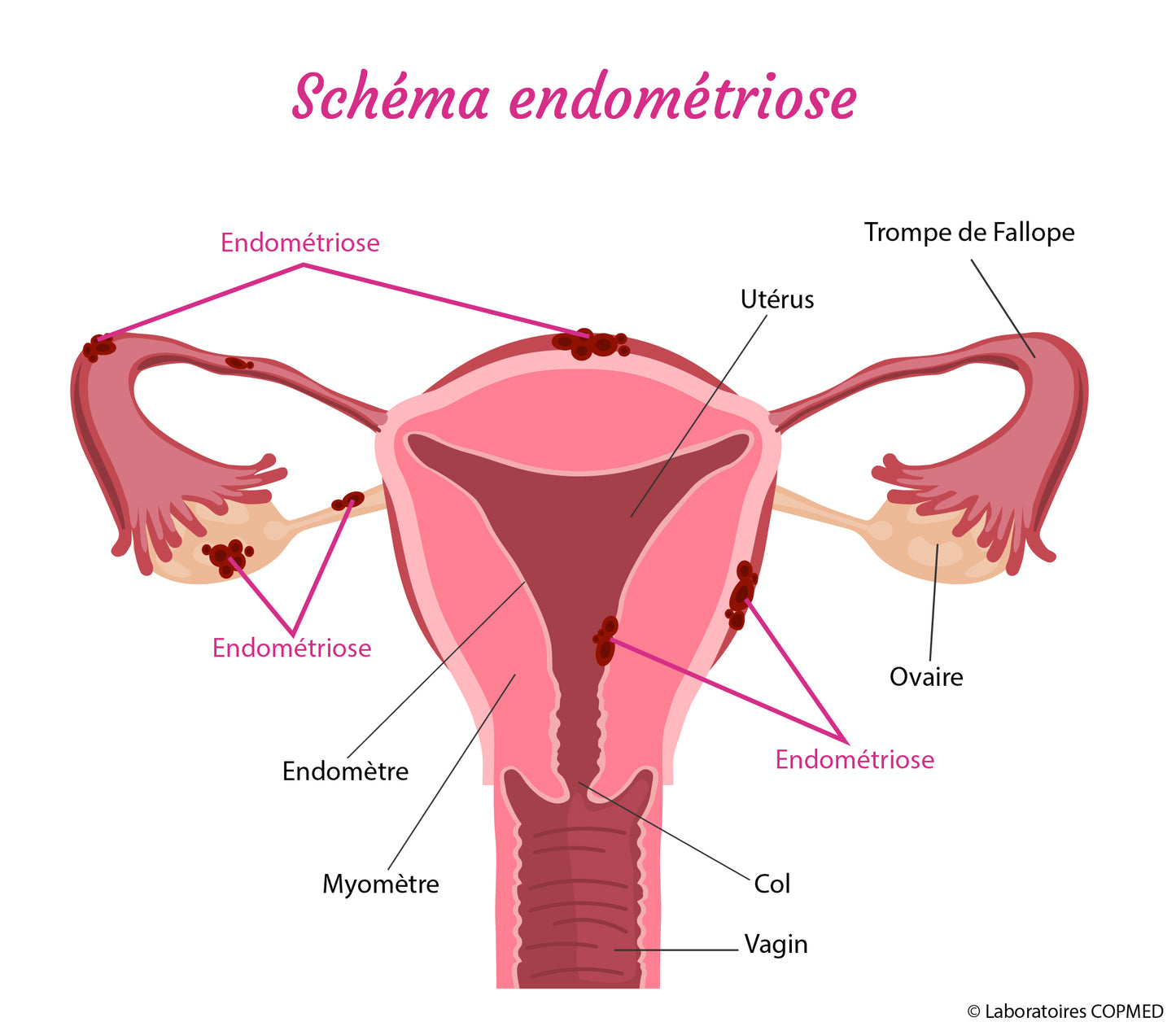 Cure Endo Équilibre – (endométriose, adénomyose, kystes…). Infusion plantes contre douleurs & inflammation