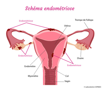 Cure Endo Équilibre – (endométriose, adénomyose, kystes…). Infusion plantes contre douleurs & inflammation